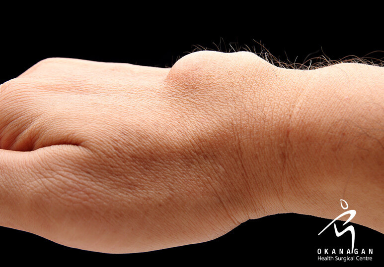Ganglion Cyst: What Is It And How Is It Treated?